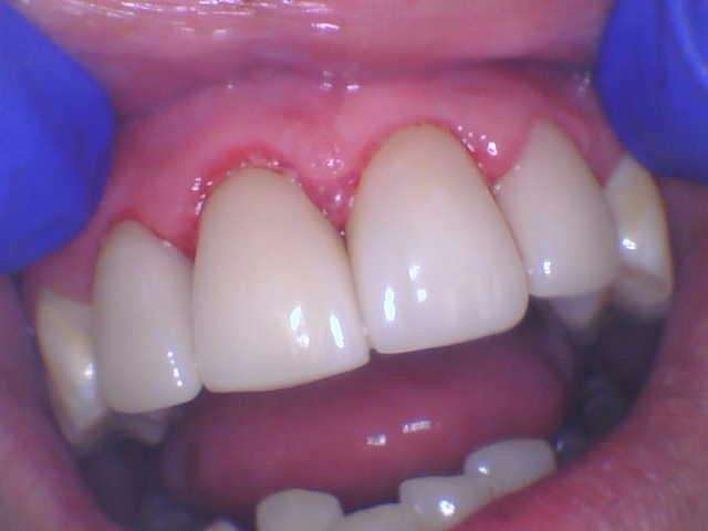 Dental-Crowns-After-Image
