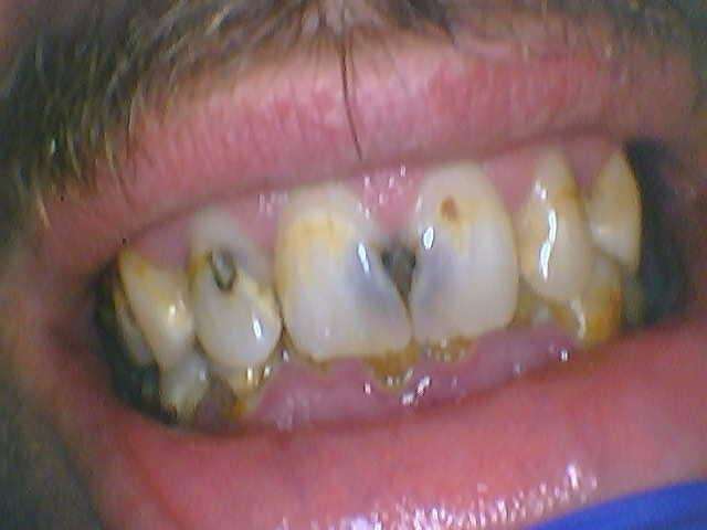 Dental-Crowns-Before-Image